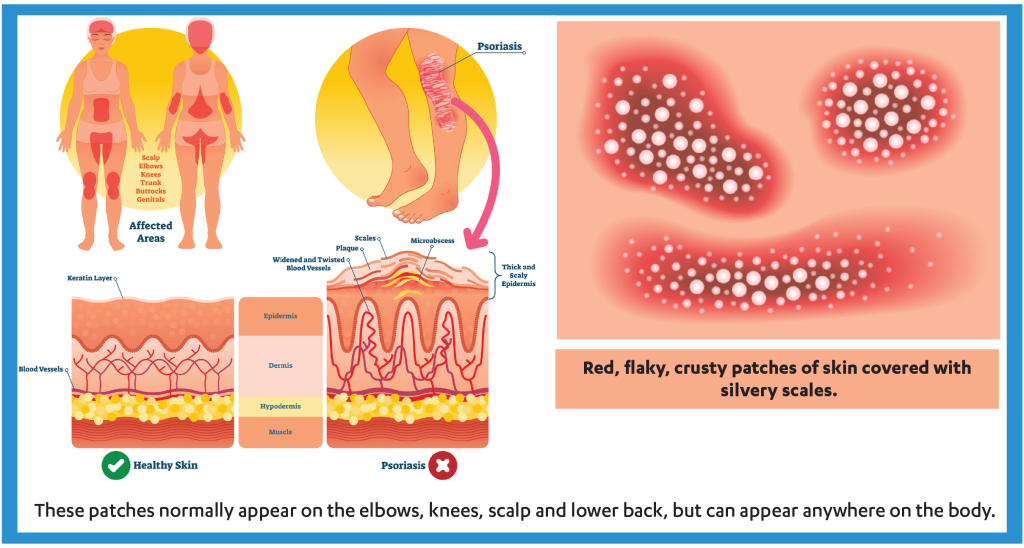 Psoriasis: Locations and Types